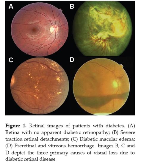 Cost treatment for diabetic retinopathy philippines