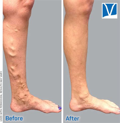 How much does varicose vein treatment cost without insurance