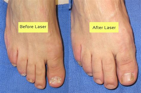 Pros and cons of laser treatment for toenail fungus