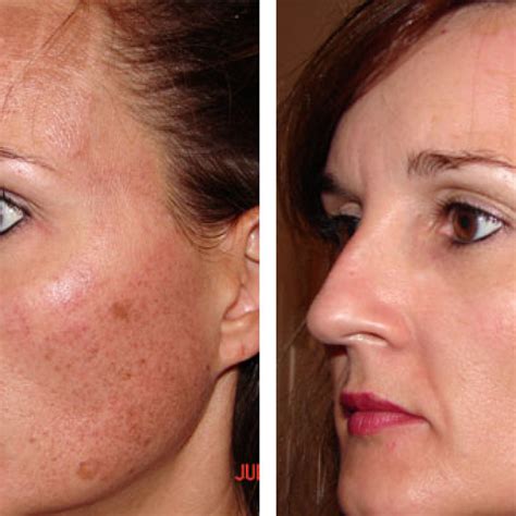 Bbl laser before and after 1 treatment