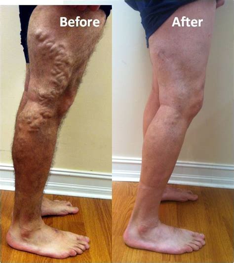 Does blue cross blue shield cover varicose vein treatment