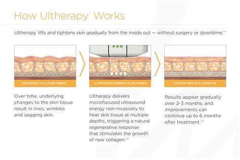 How many ultherapy treatments are needed