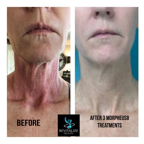 Morpheus8 before and after 3 treatments