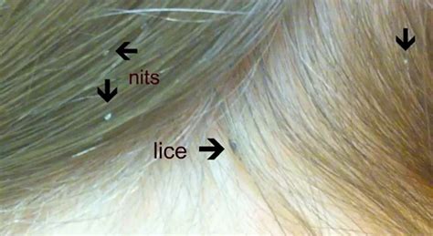 How long after lice treatment can you get a haircut