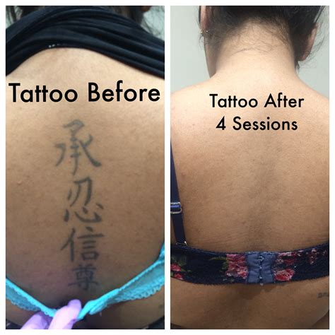 How many treatments for tattoo removal