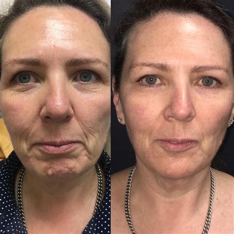 What is the best non surgical treatment for jowls