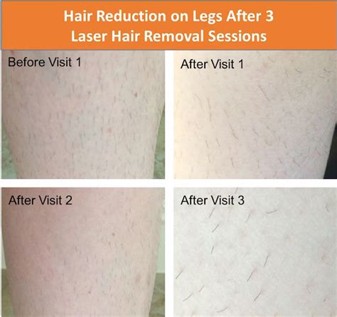 How many laser hair removal treatments for brazilian