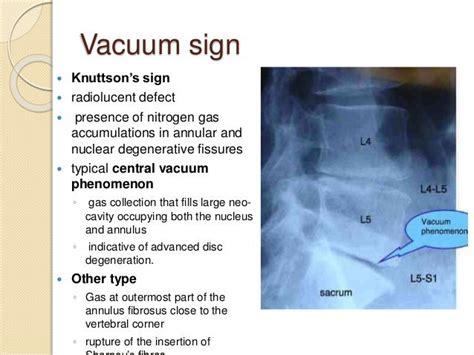 What is the treatment for vacuum disc phenomenon