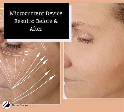 How often should microcurrent treatments occur for visible results
