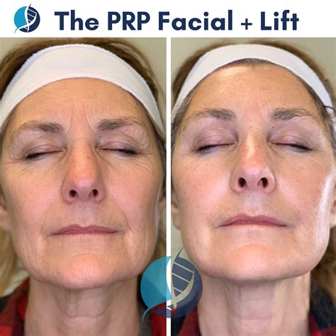 How many prp treatments are needed for face