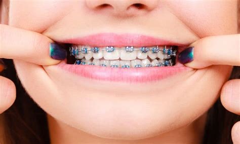 Can i switch orthodontists during treatment