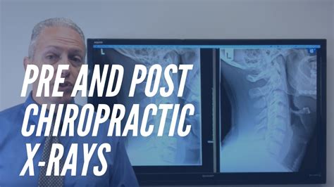 Should a chiropractor take x rays before treatment